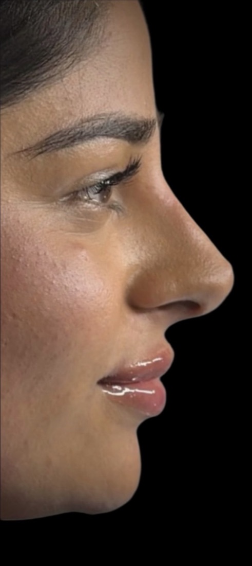 Lips after filler — softly defined, in profile