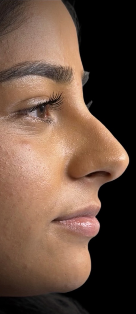 Lips before filler, in profile