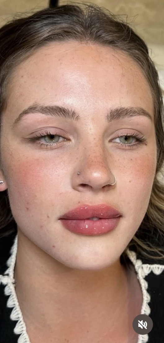 Lips after filler — soft and balanced