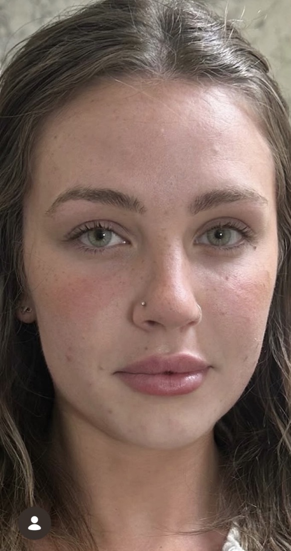 Lips before filler