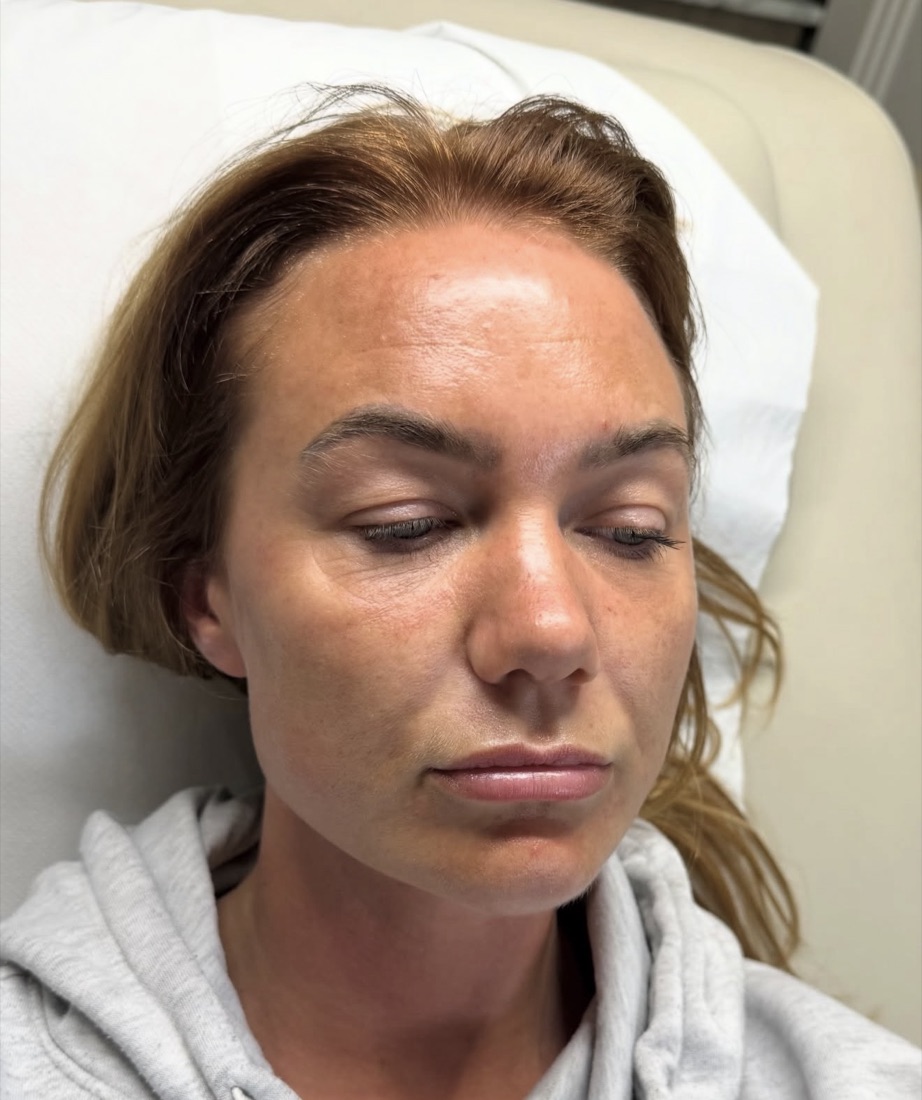 Skin before — uneven and flushed