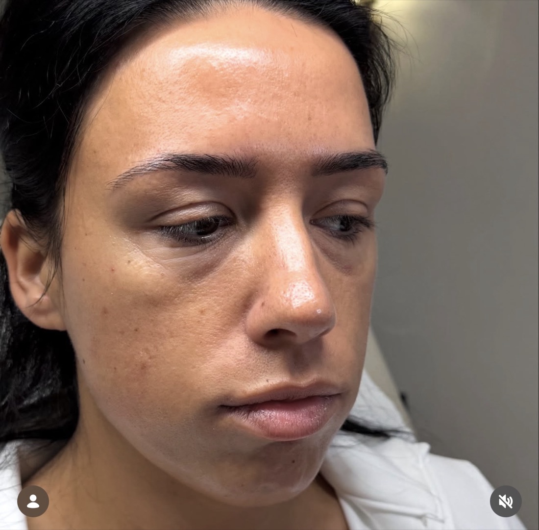 Skin before — dull, uneven texture